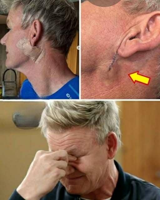 Fans in Shock as Gordon Ramsay Reveals Cancer Battle — TV Chef Shows Surgery Scars After Devastating Diagnosis