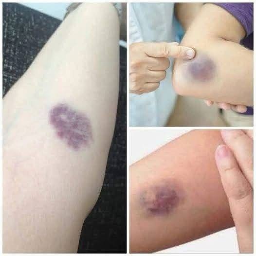 Unexplained bruises? Here’s what your body might be trying to tell you.
