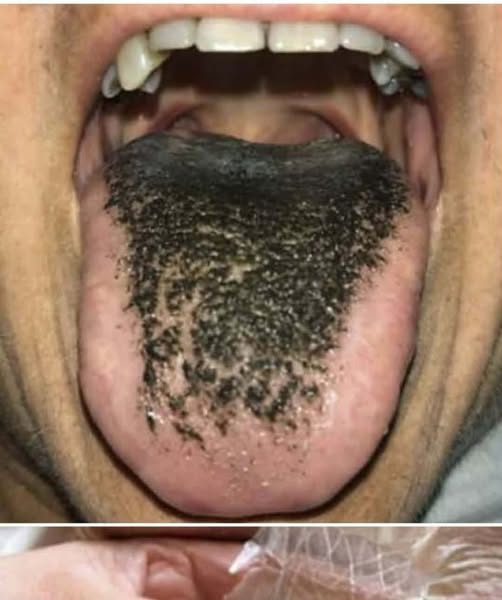 What a White Tongue May Indicate: Causes, Prevention, and When to Seek Medical Advice